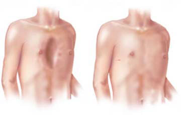 Göğüs duvarı deformitesi
